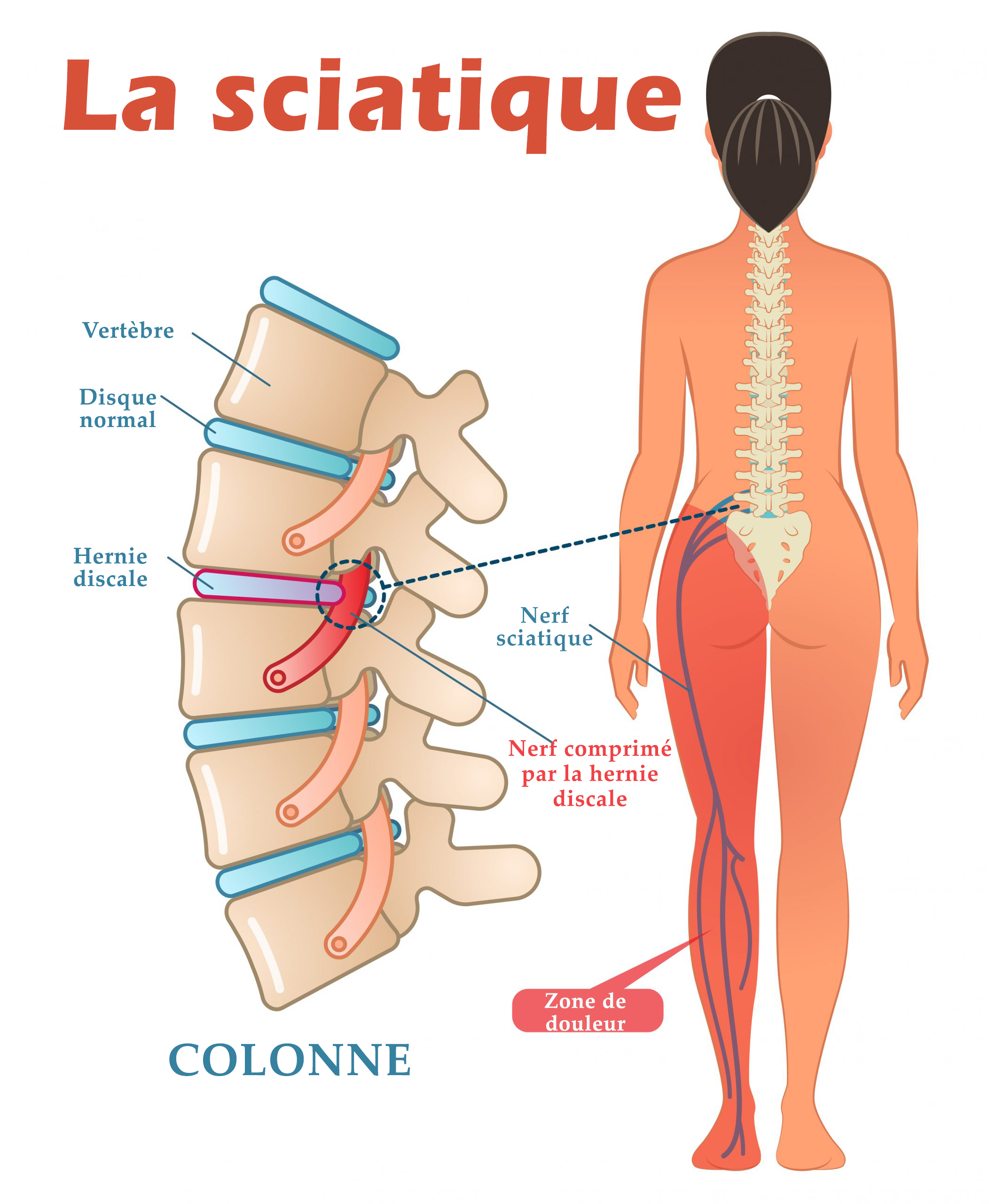 Diagnostic différentiel de la douleur radiculaire - Physio Network