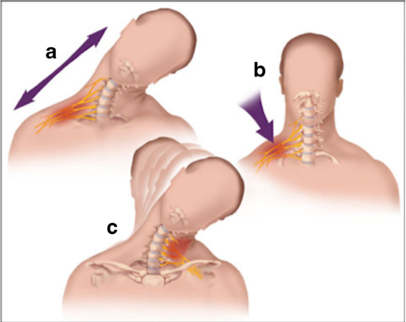 Comment évaluer les traumatismes du plexus brachial - Physio Network