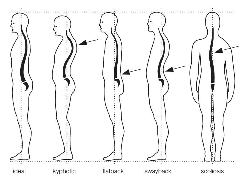 Why Posture and Pain do not Simply Relate