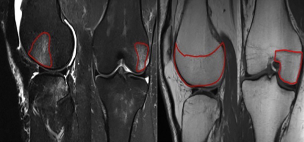 Bone Bruise Im Fu knochen Knochenmark dem Ursache Symptome