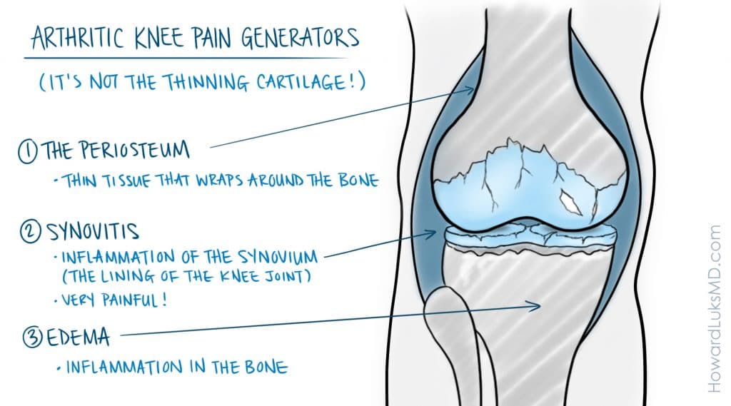 10 Recommendations To Thrive With Osteoarthritis Of The Knee