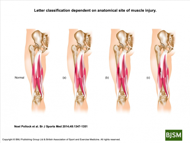 How to rehab calf strains in runners - Physio Network