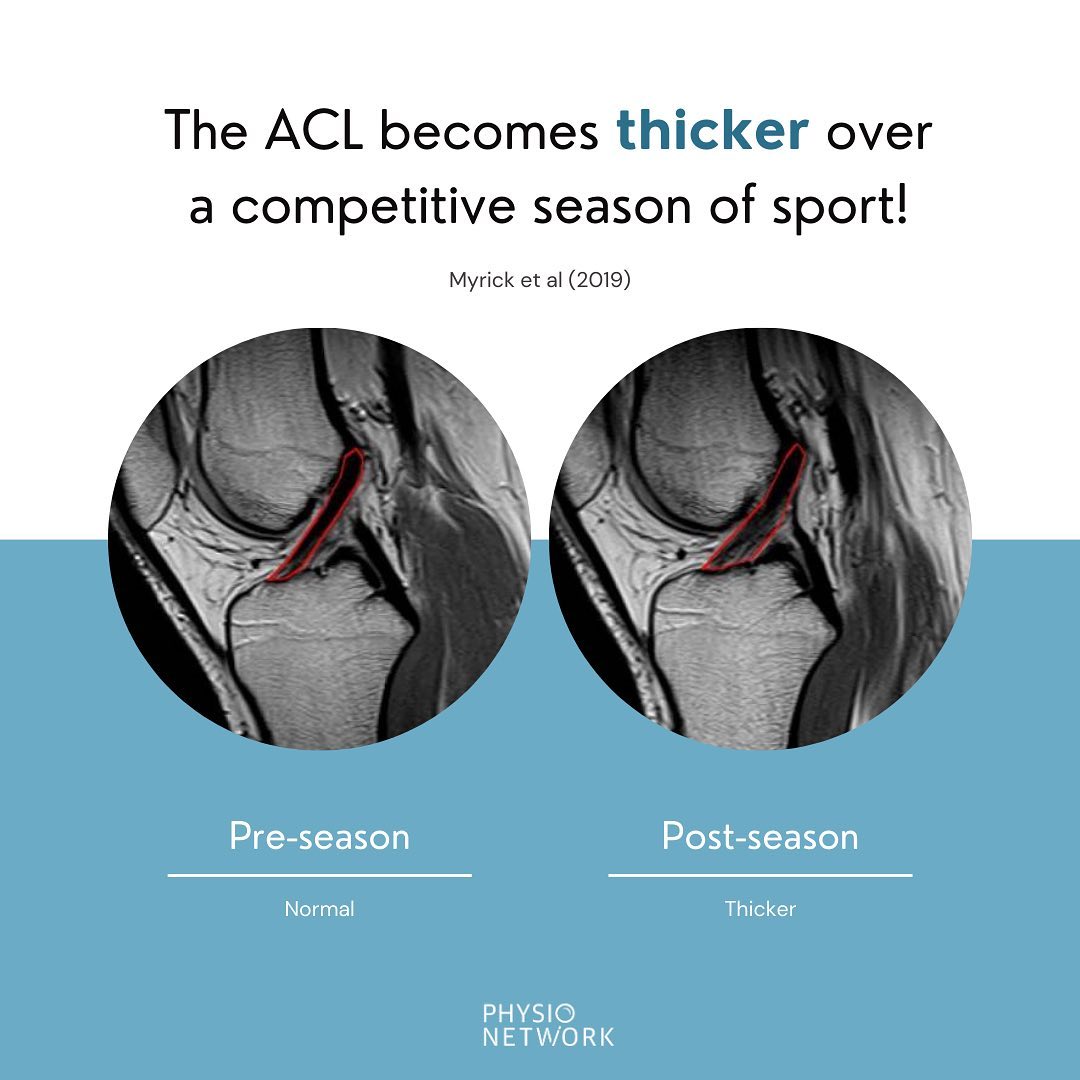 Free Infographic On ACL Injuries | Physio Therapists