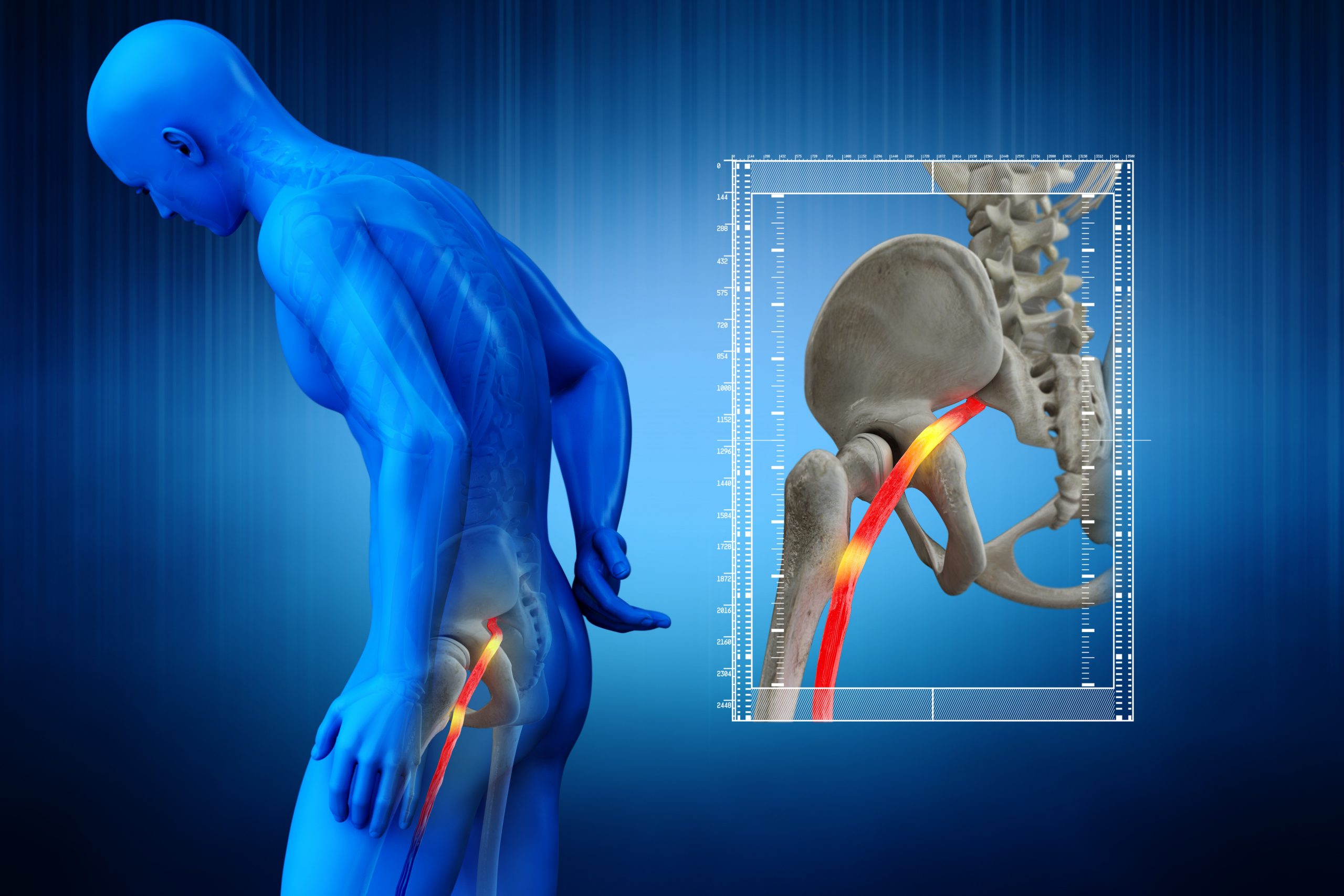 Sciatica Case Study: Bringing Research Into Practice - Physio Network
