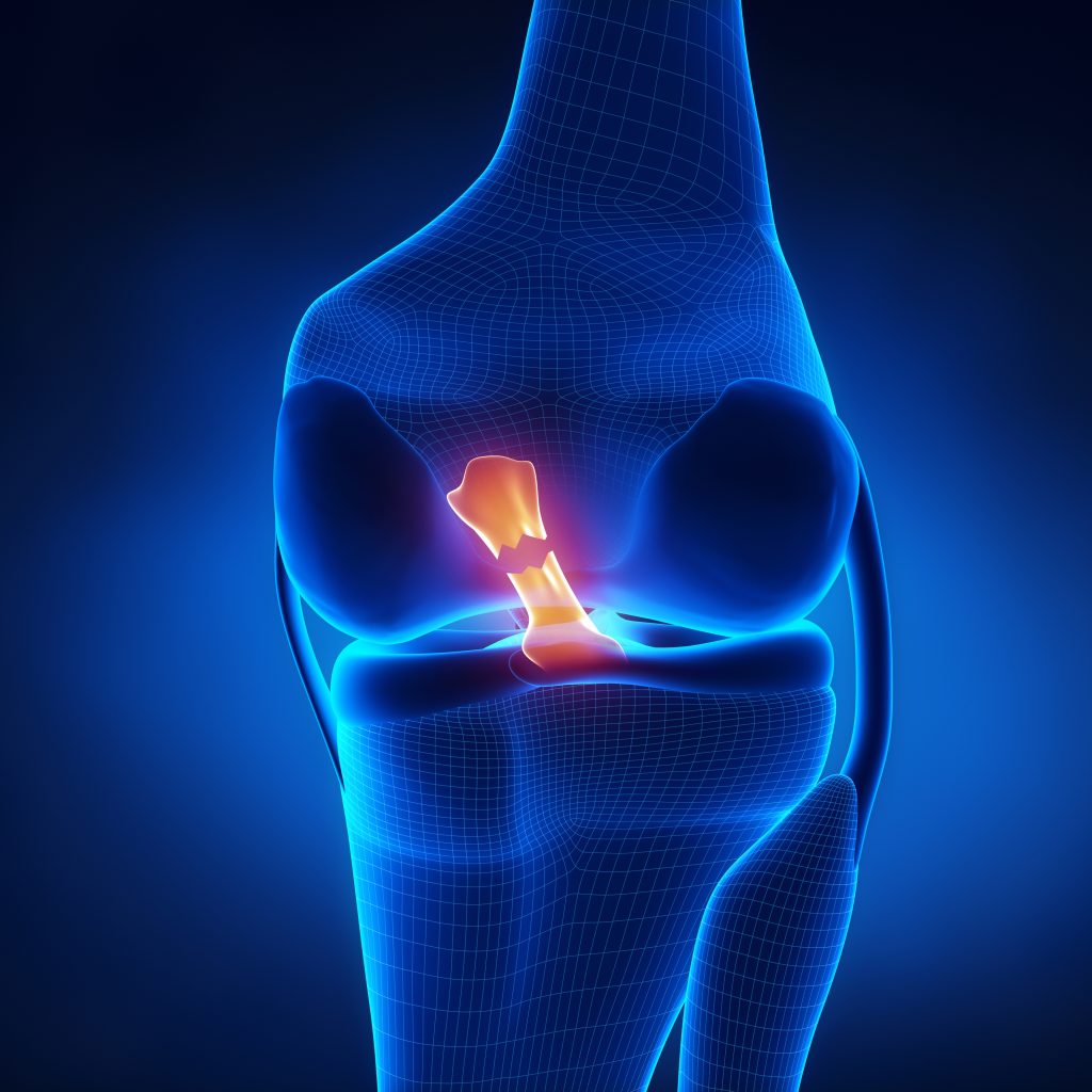 The ACL Healing Phenomenon: Science Or Myth? — Physio Network