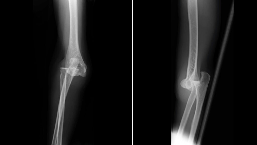 Post Elbow Dislocation From Research To Practice: Post-Elbow Dislocation — Physio Network